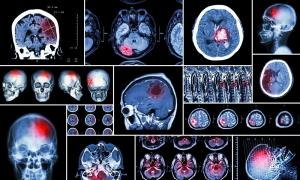 Частые вопросы о мрт-исследованиях Когда нельзя делать КТ и МРТ